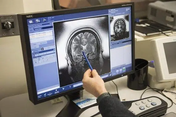 L’imagerie cérébrale pourrait percer les mystères de l’Alzheimer